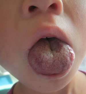 孩子舌头上有血管瘤怎么办