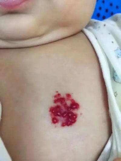 婴儿浅表血管瘤会消退吗？